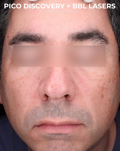 BBL Laser Before & After Gallery - Patient 286352 - Image 1
