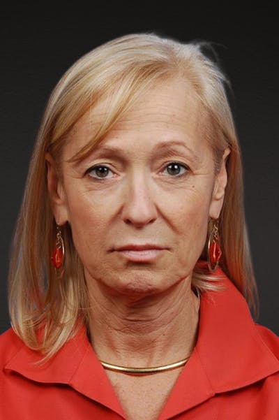 Facelift Before & After Gallery - Patient 423612 - Image 1