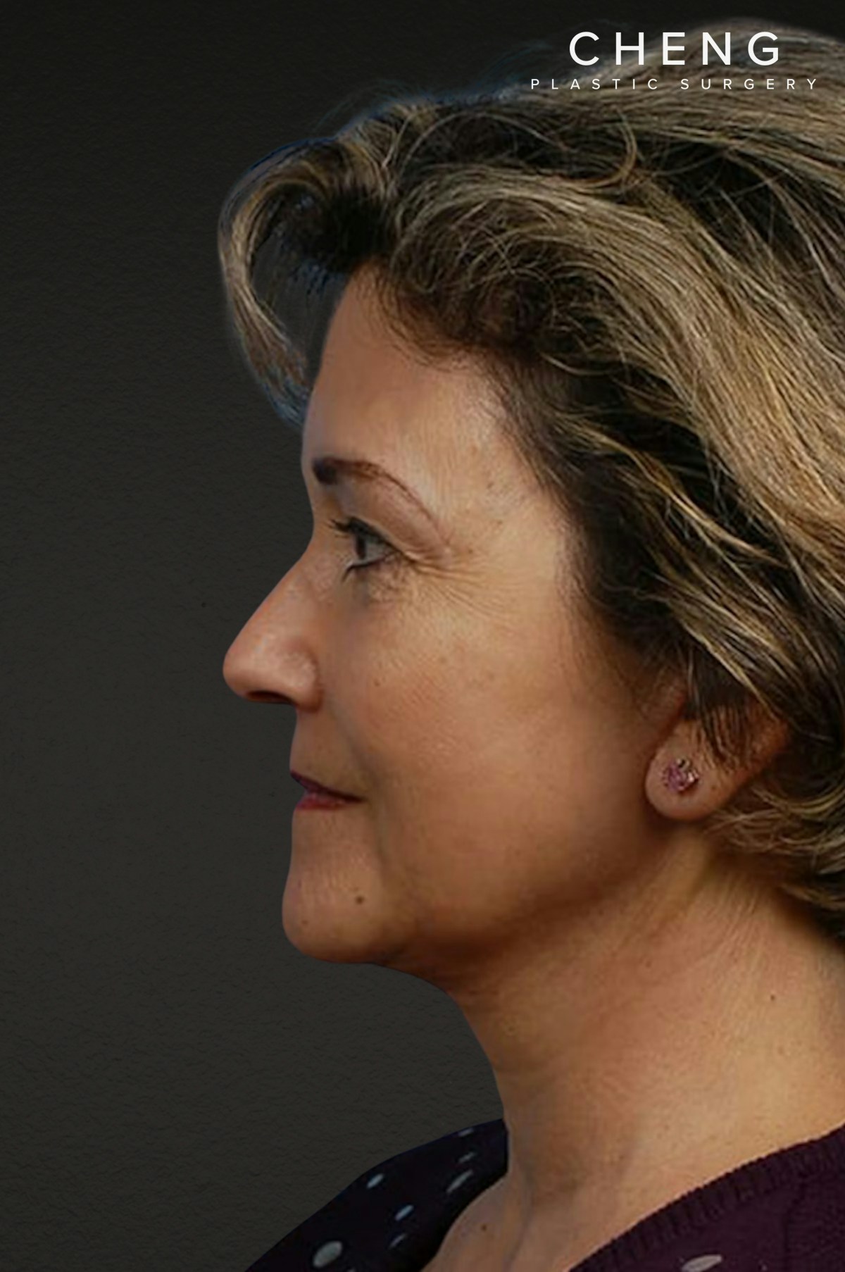 Facelift Before & After Gallery - Patient 976634 - Image 2