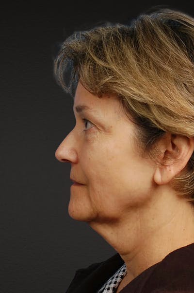 Facelift Before & After Gallery - Patient 976634 - Image 1