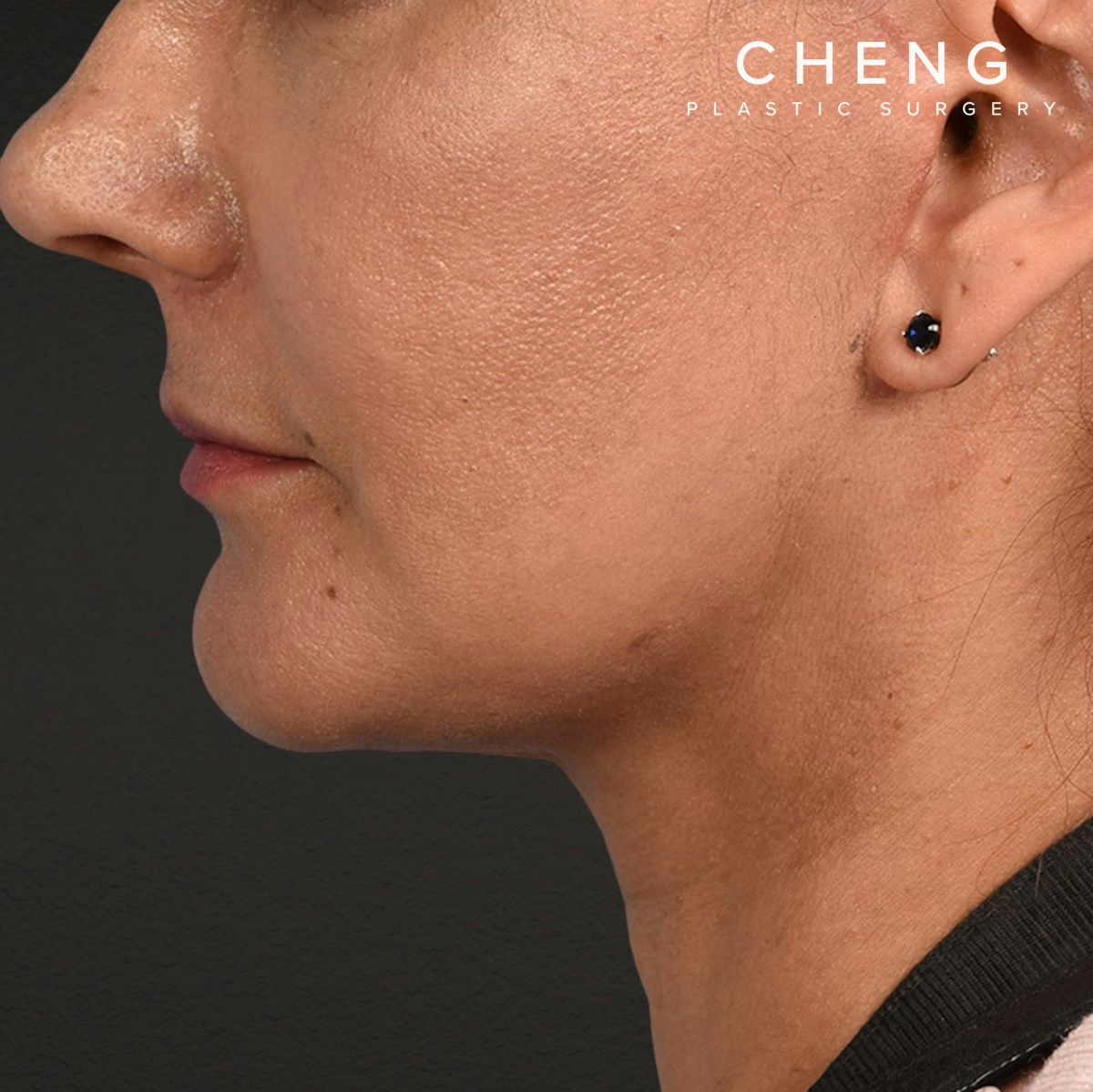 Facelift Before & After Gallery - Patient 230740 - Image 10