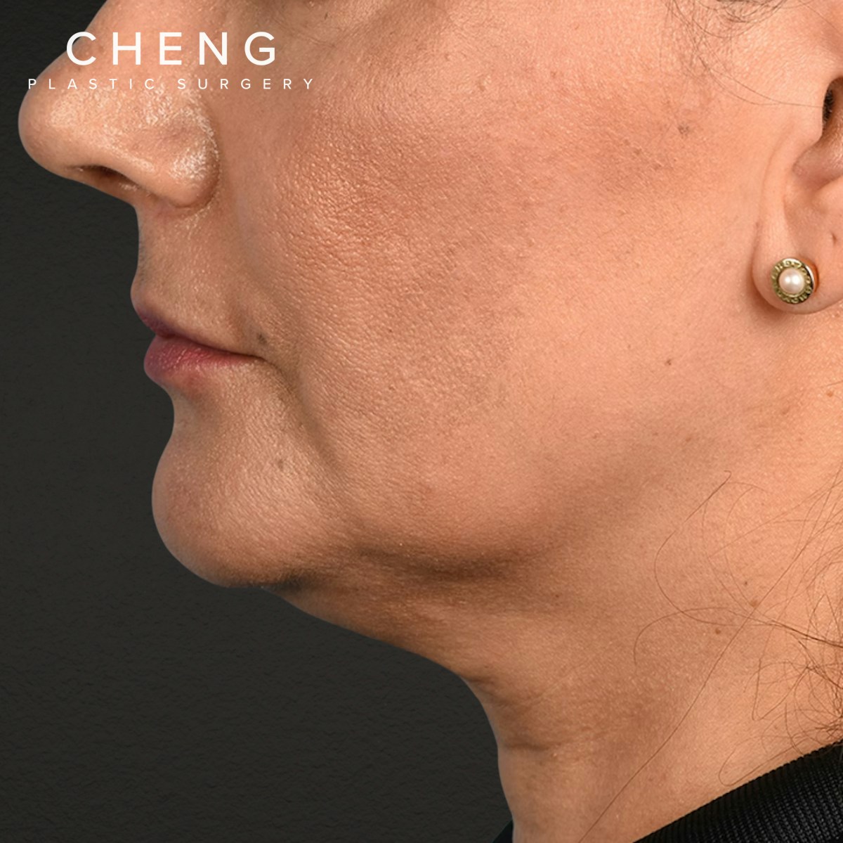 Facelift Before & After Gallery - Patient 230740 - Image 9