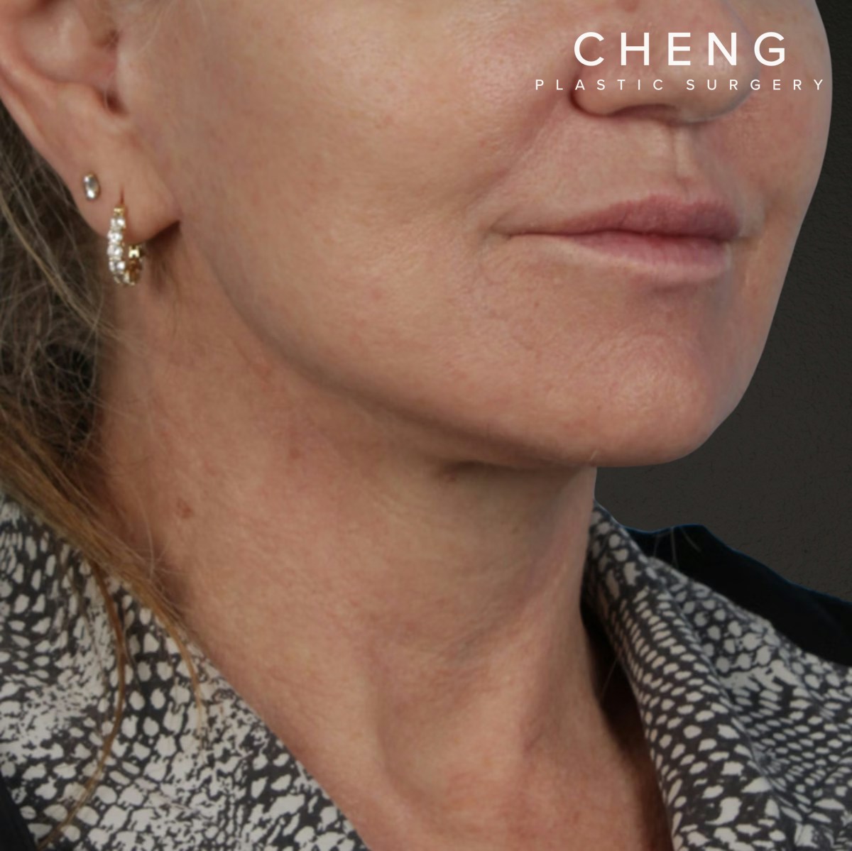Facelift Before & After Gallery - Patient 315359 - Image 4