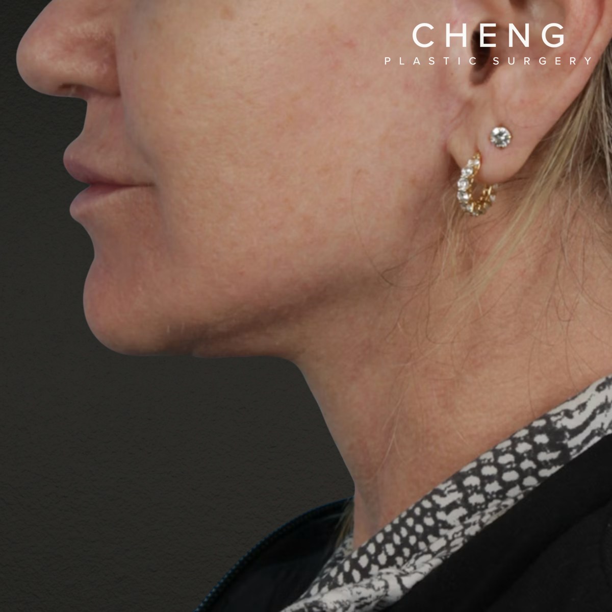 Facelift Before & After Gallery - Patient 315359 - Image 10