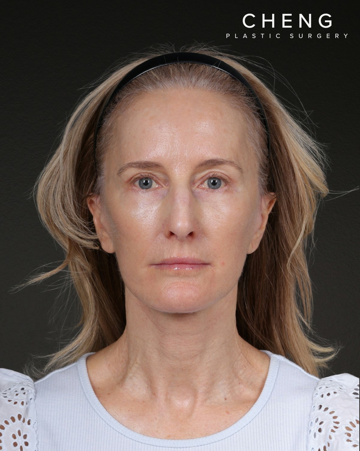 Co2 Laser Before & After Gallery - Patient 497723 - Image 6