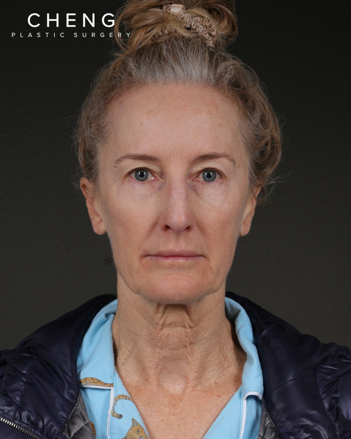 Co2 Laser Before & After Gallery - Patient 497723 - Image 5
