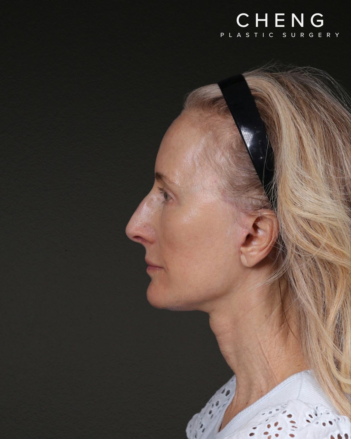 Co2 Laser Before & After Gallery - Patient 497723 - Image 10