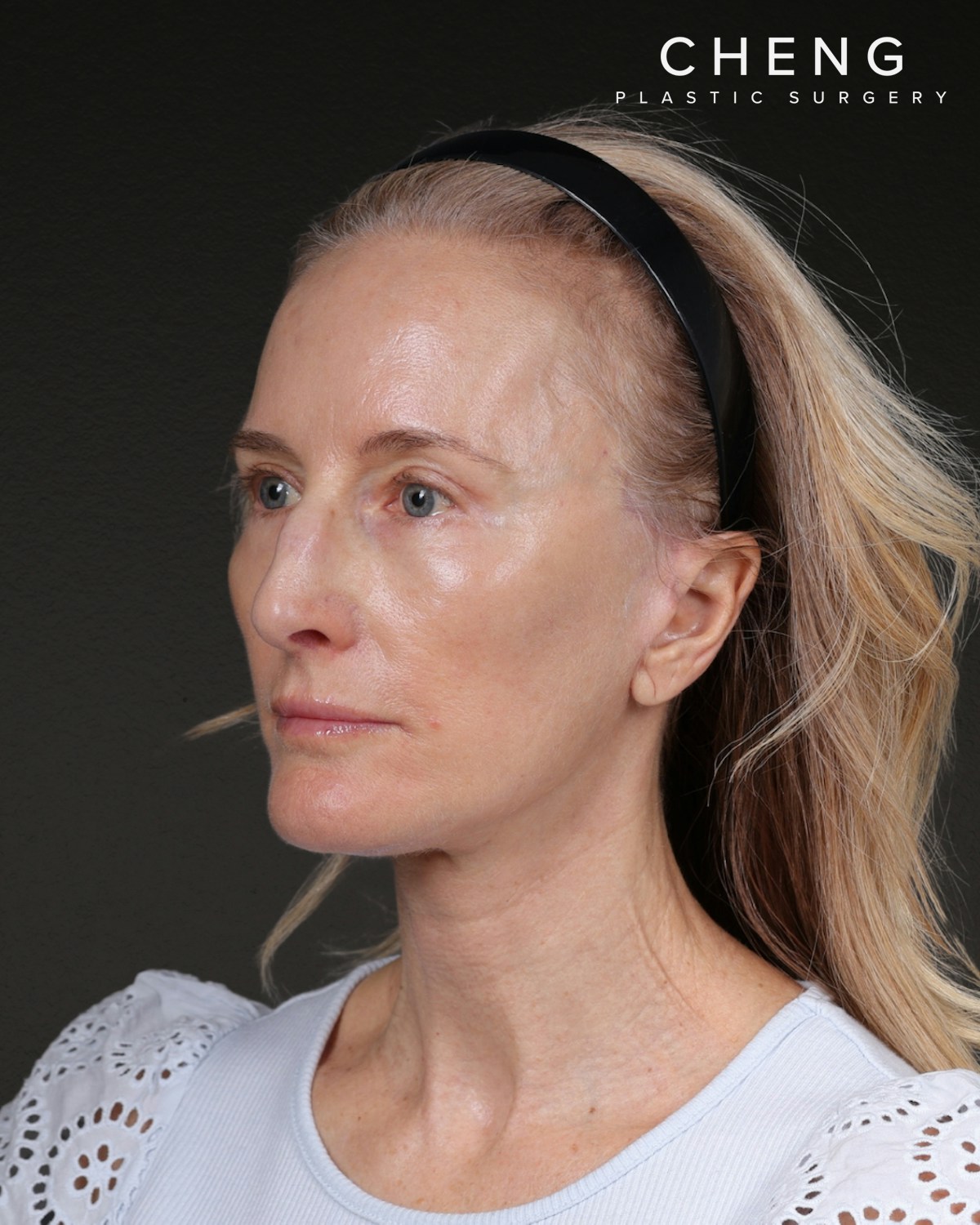 Co2 Laser Before & After Gallery - Patient 497723 - Image 8