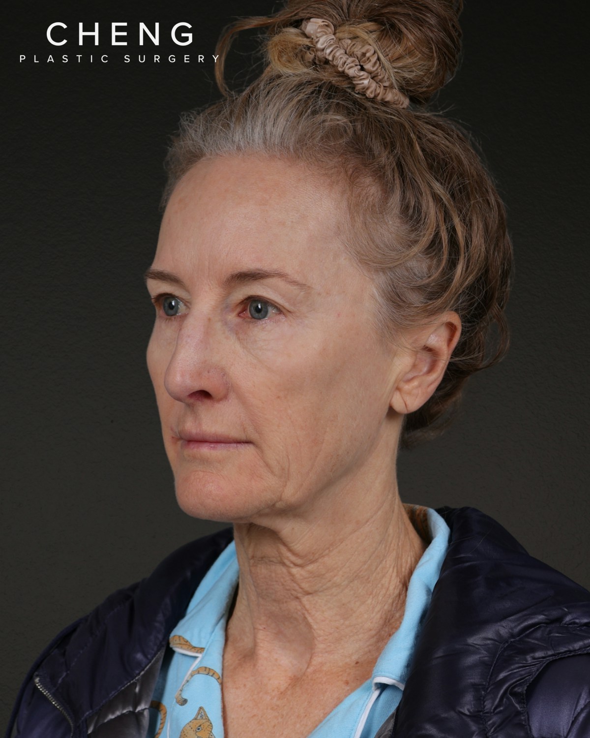 Co2 Laser Before & After Gallery - Patient 497723 - Image 7