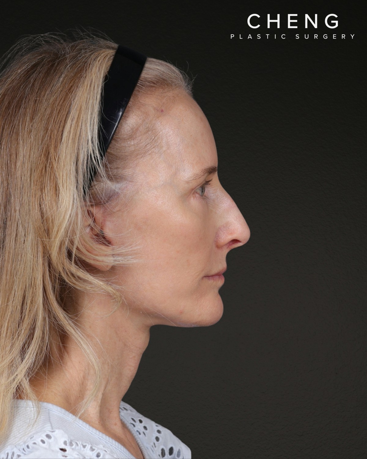 Co2 Laser Before & After Gallery - Patient 497723 - Image 4