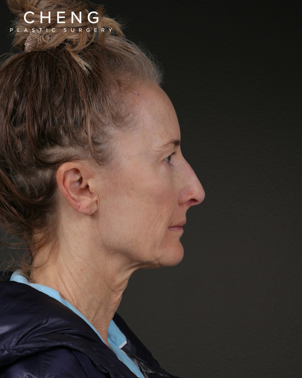 Co2 Laser Before & After Gallery - Patient 497723 - Image 3