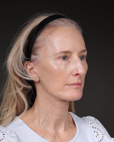 Fat Grafting Before & After Gallery - Patient 142033 - Image 2