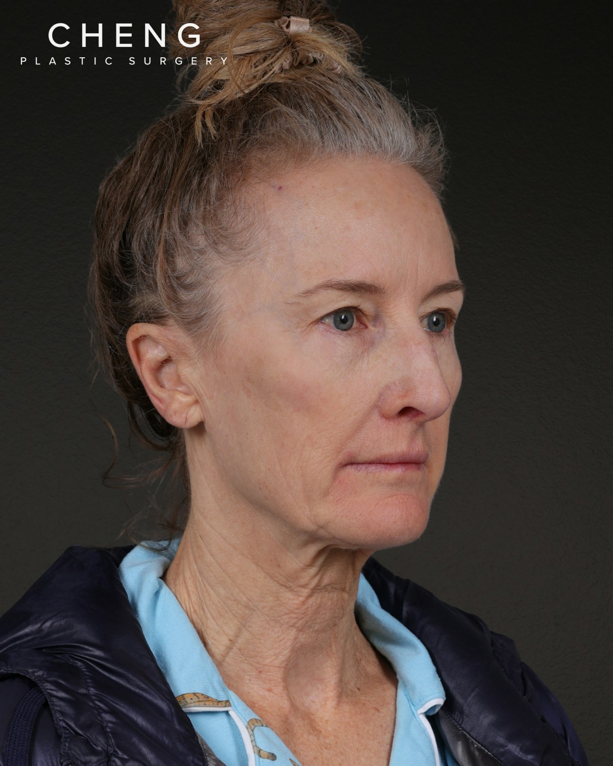 Co2 Laser Before & After Gallery - Patient 497723 - Image 1