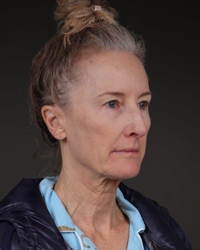 Fat Grafting Before & After Gallery - Patient 142033 - Image 1