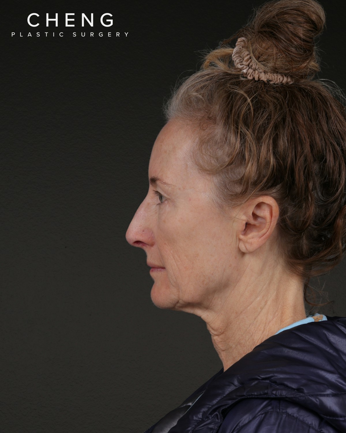 Co2 Laser Before & After Gallery - Patient 497723 - Image 9