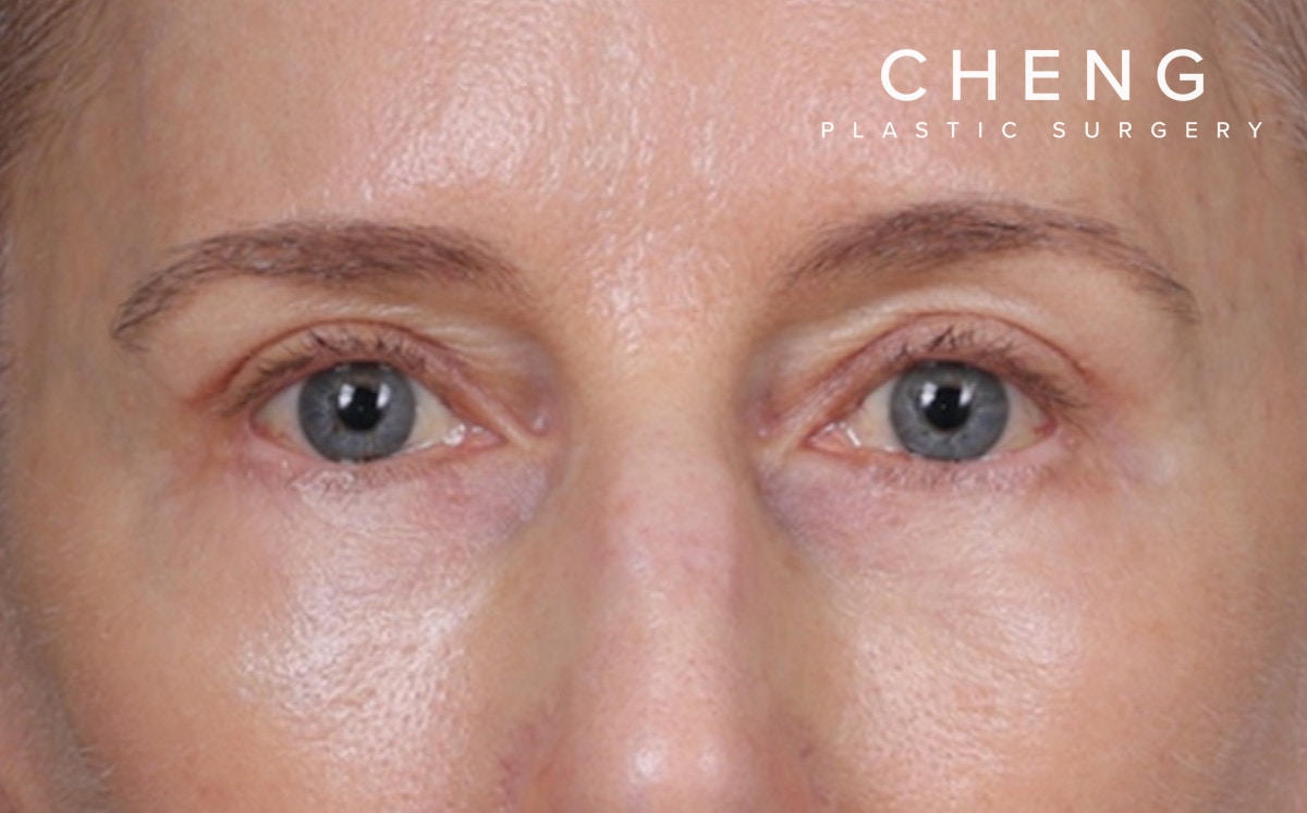 Blepharoplasty Before & After Gallery - Patient 390265 - Image 2