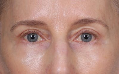 Blepharoplasty Before & After Gallery - Patient 390265 - Image 2