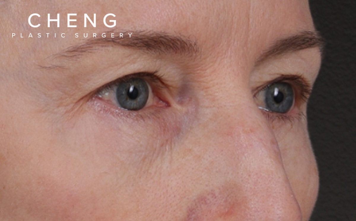 Blepharoplasty Before & After Gallery - Patient 390265 - Image 3