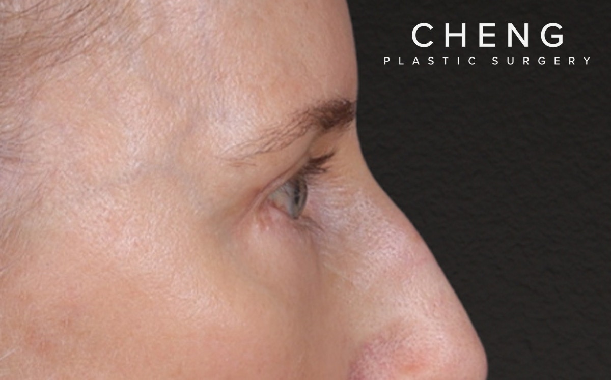 Blepharoplasty Before & After Gallery - Patient 390265 - Image 6