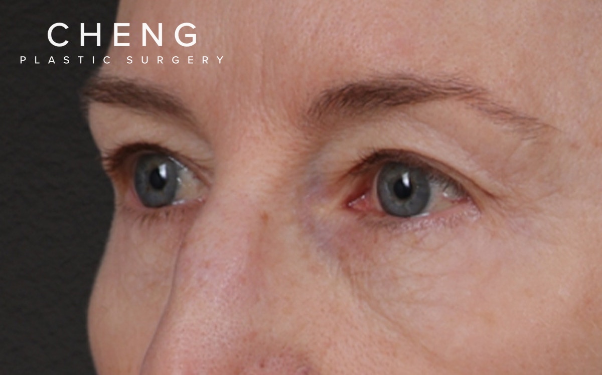 Blepharoplasty Before & After Gallery - Patient 390265 - Image 7