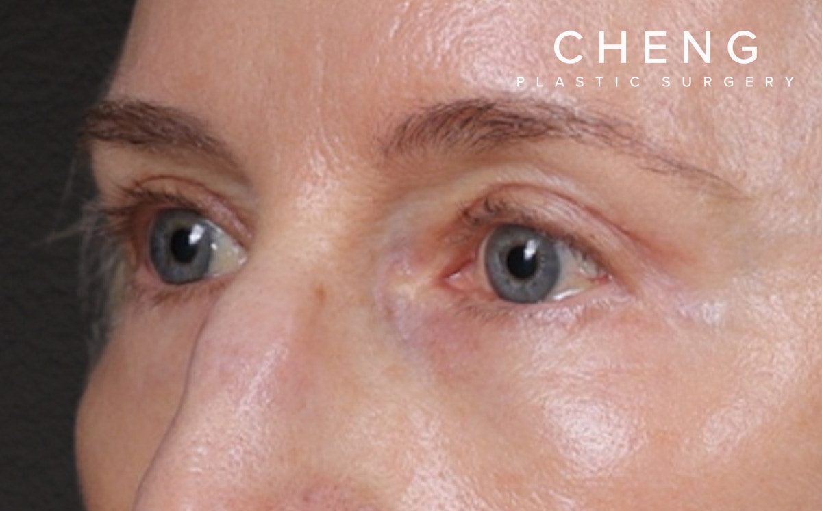 Blepharoplasty Before & After Gallery - Patient 390265 - Image 8