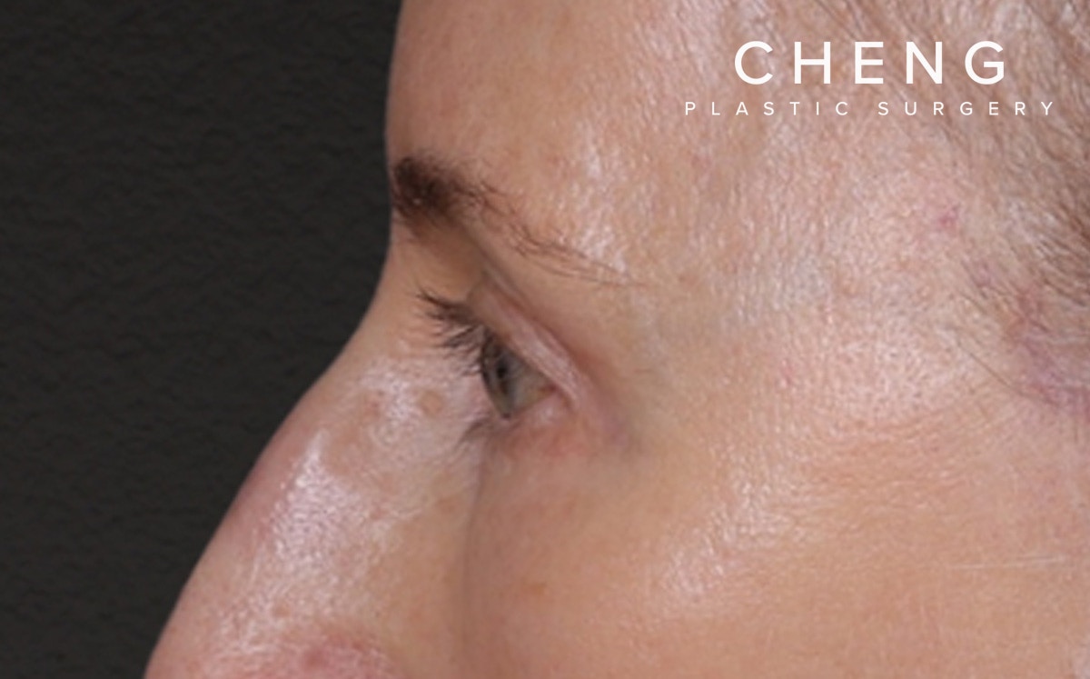 Blepharoplasty Before & After Gallery - Patient 390265 - Image 10