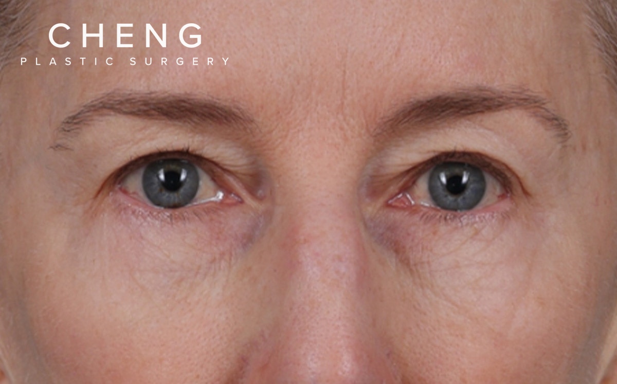 Blepharoplasty Before & After Gallery - Patient 390265 - Image 1