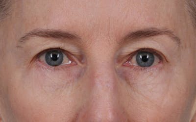 Blepharoplasty Before & After Gallery - Patient 390265 - Image 1