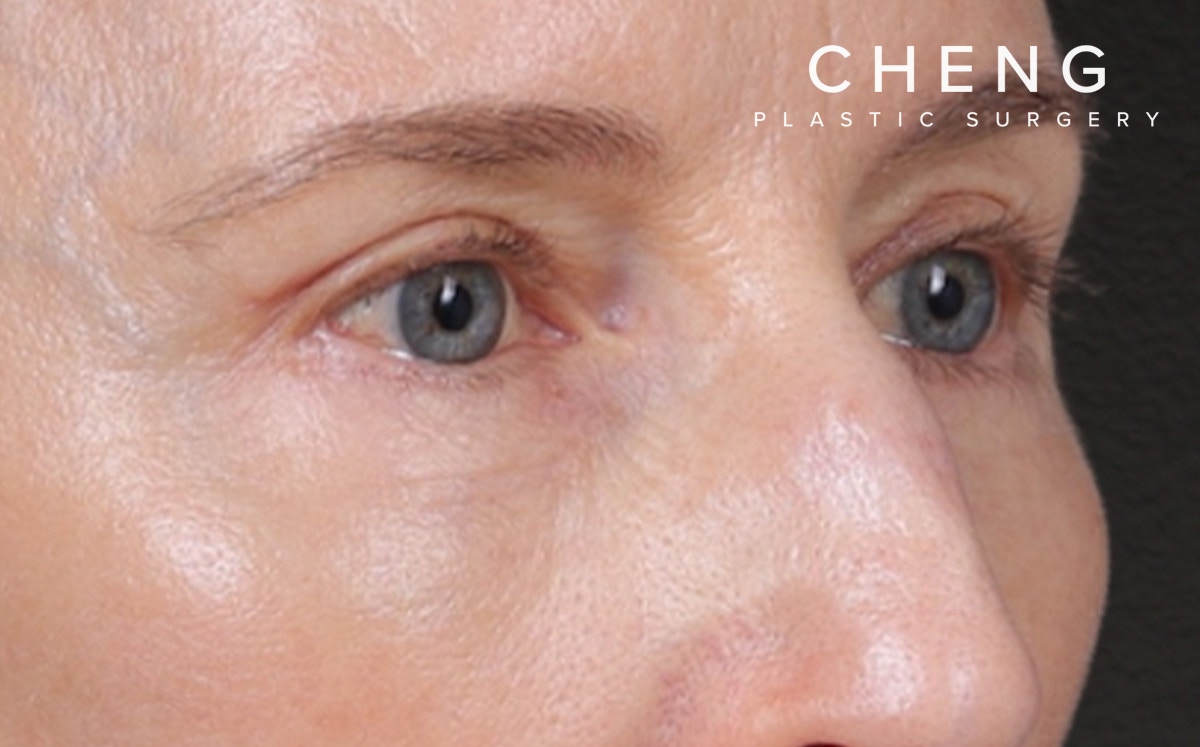 Blepharoplasty Before & After Gallery - Patient 390265 - Image 4