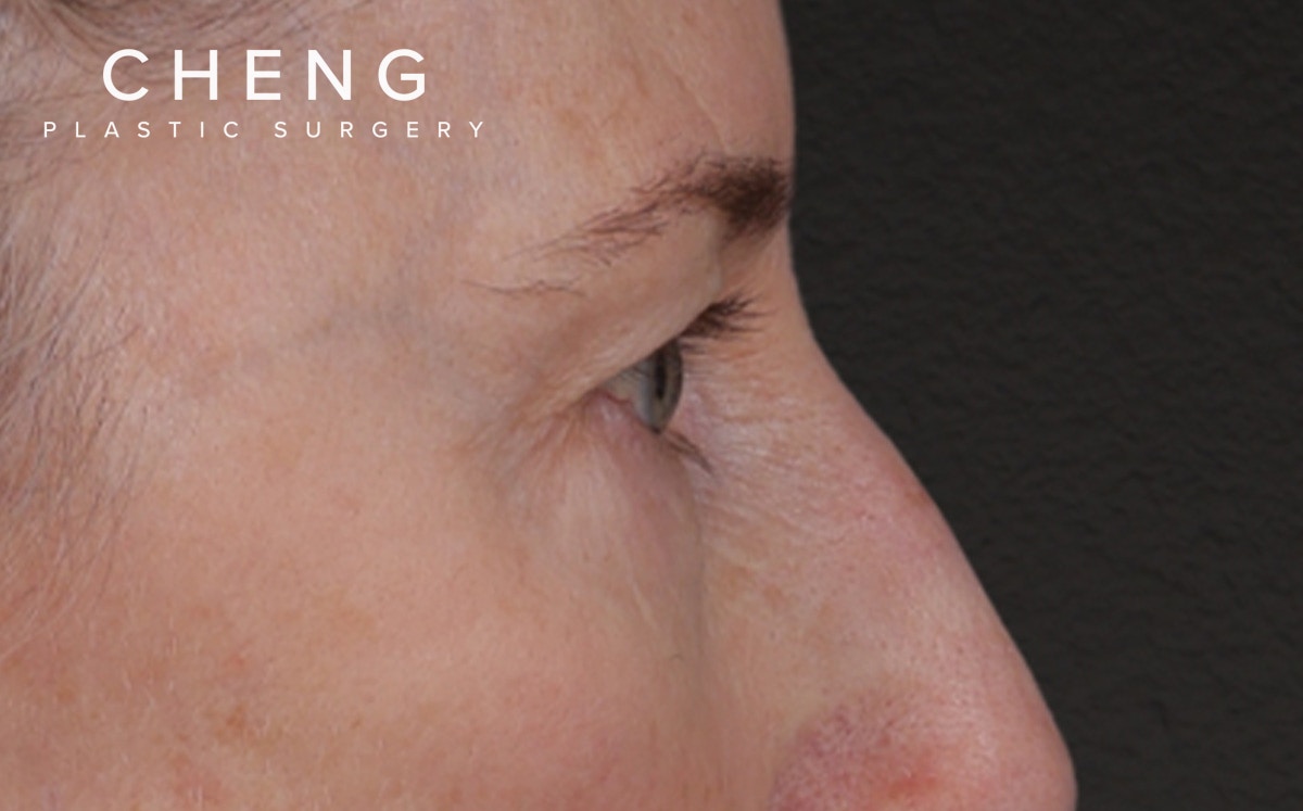 Blepharoplasty Before & After Gallery - Patient 390265 - Image 5