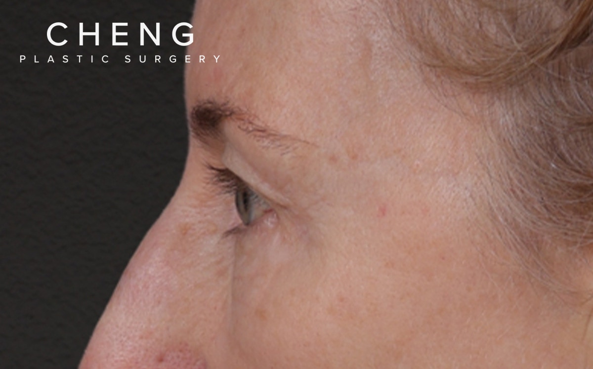 Blepharoplasty Before & After Gallery - Patient 390265 - Image 9