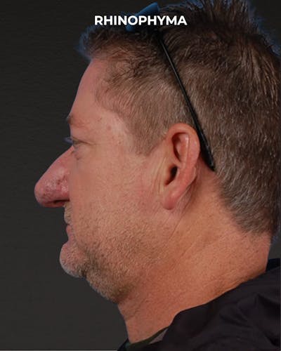 Rhinoplasty Before & After Gallery - Patient 236748 - Image 1