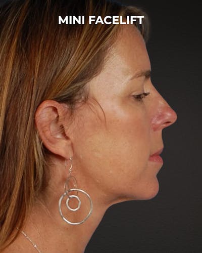 Facelift Before & After Gallery - Patient 244293 - Image 2