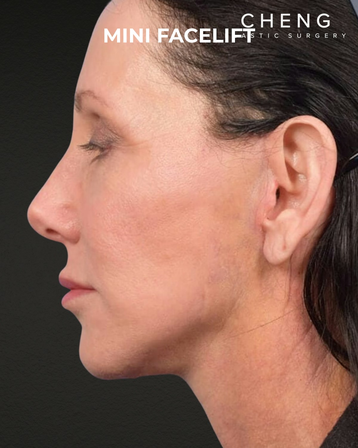 Facelift Before & After Gallery - Patient 325352 - Image 4