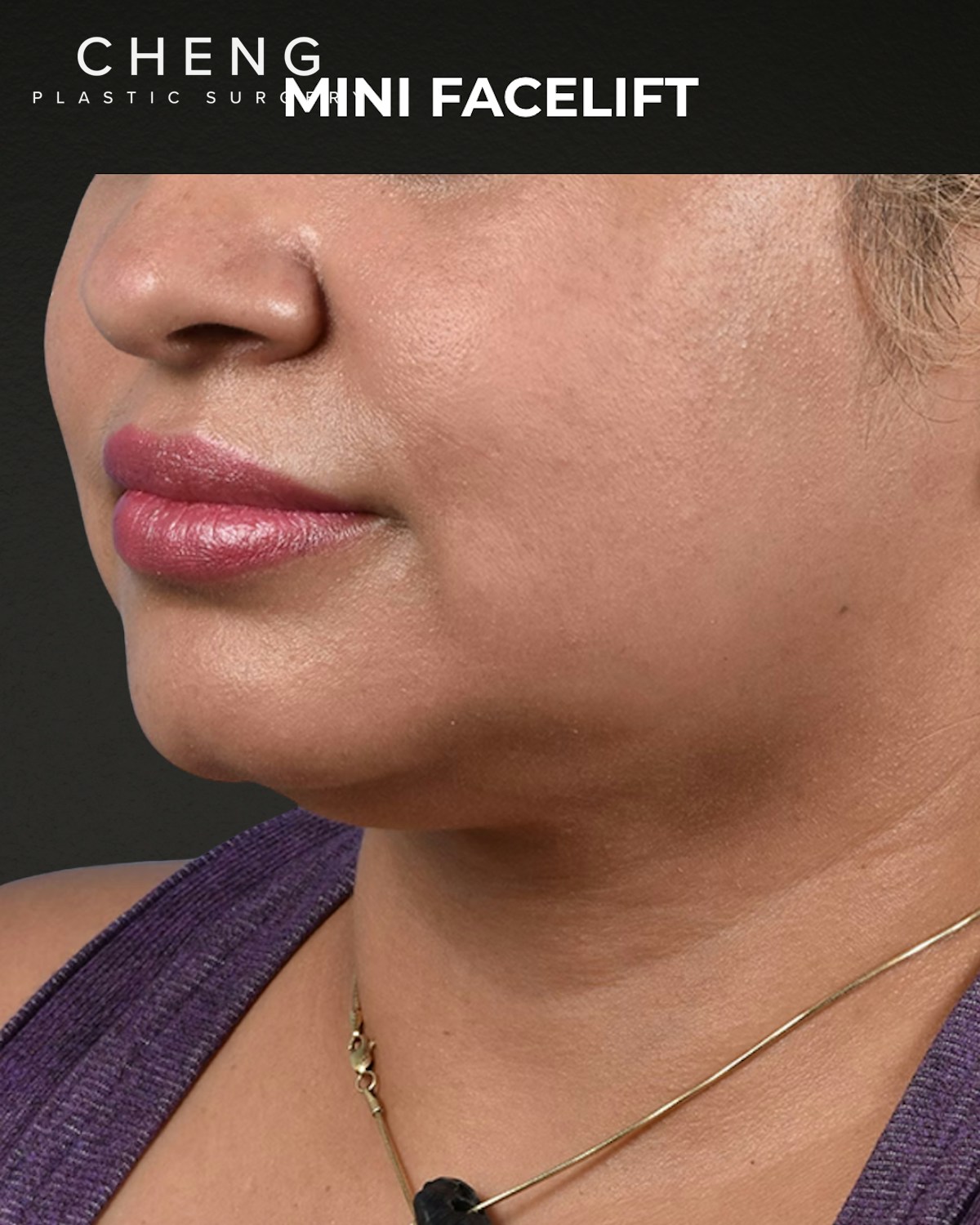 Facelift Before & After Gallery - Patient 508752 - Image 3