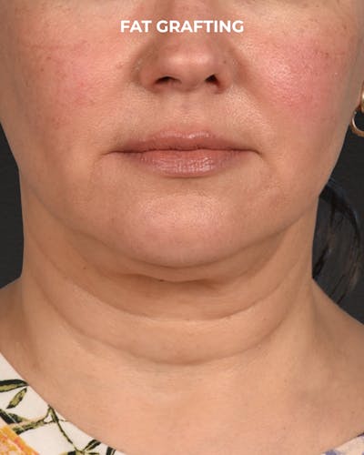 Fat Grafting Before & After Gallery - Patient 239537 - Image 1