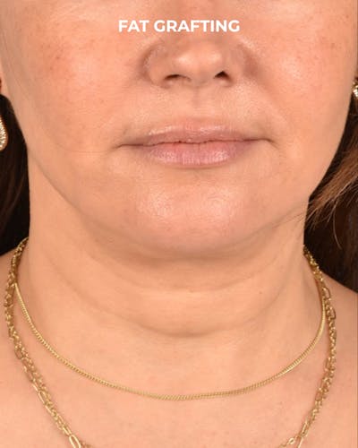 Fat Grafting Before & After Gallery - Patient 239537 - Image 2