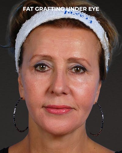 Fat Grafting Before & After Gallery - Patient 333366 - Image 2