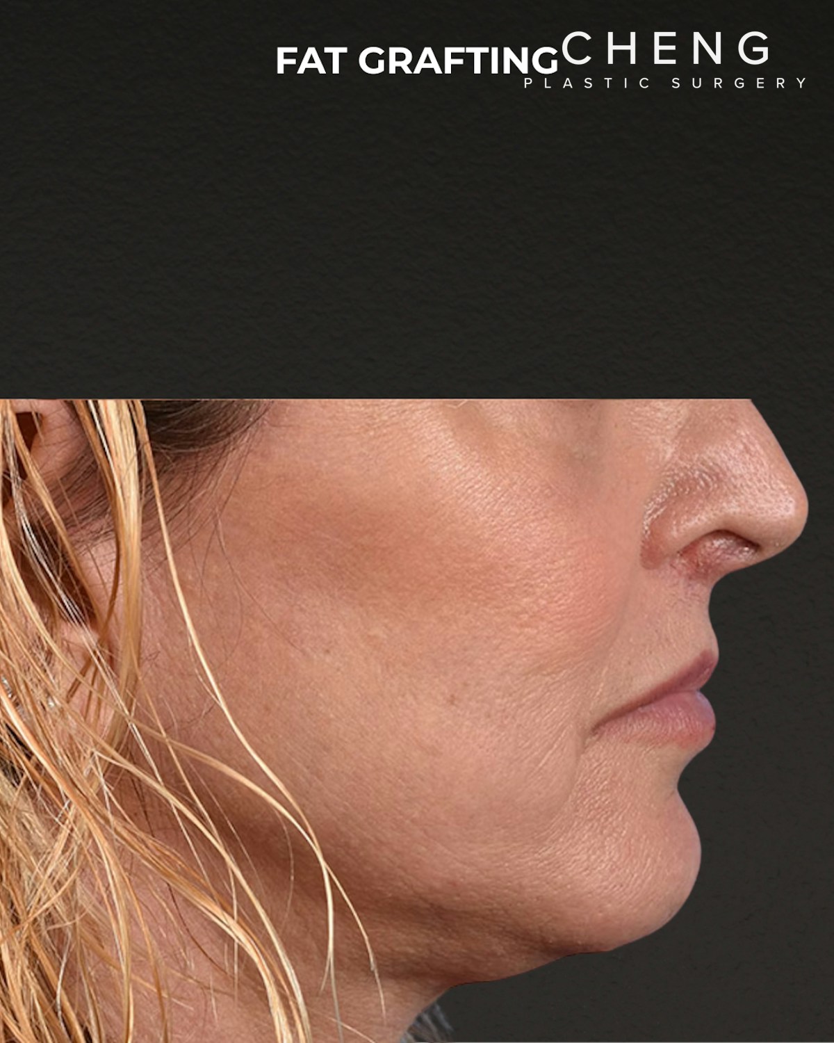 Fat Grafting Before & After Gallery - Patient 307741 - Image 4
