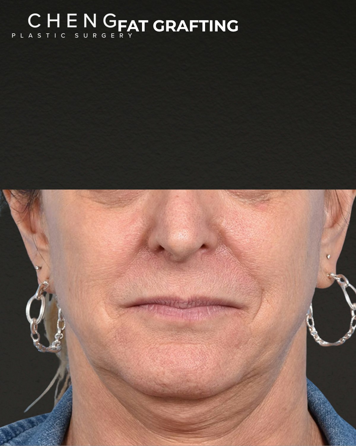 Fat Grafting Before & After Gallery - Patient 307741 - Image 1