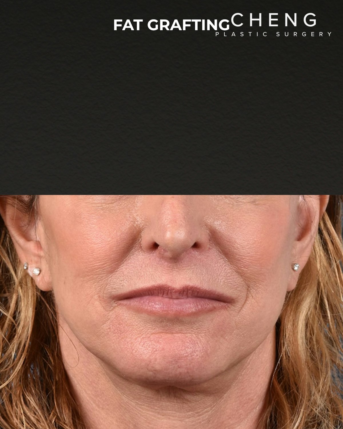 Fat Grafting Before & After Gallery - Patient 307741 - Image 2