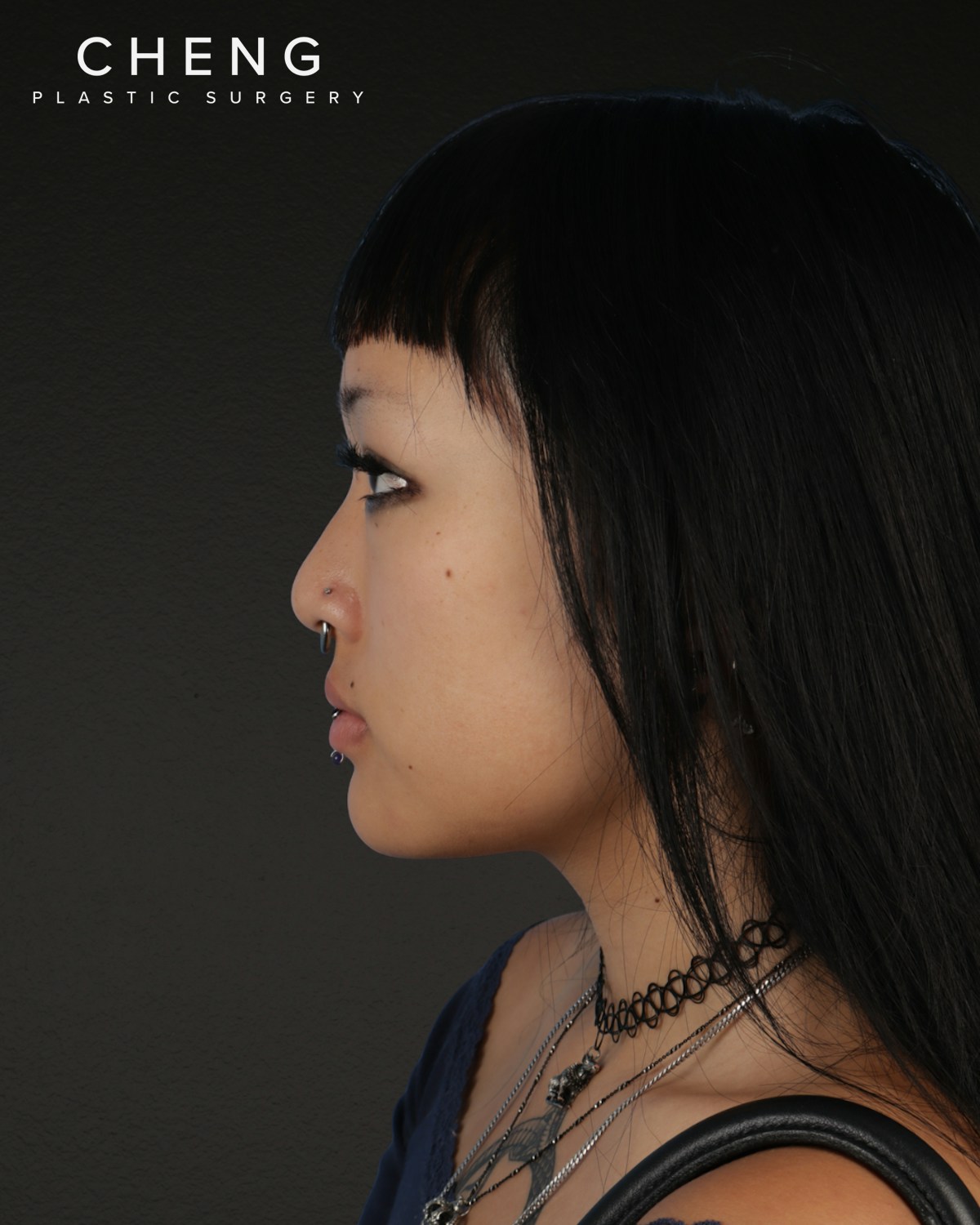 Rhinoplasty Before & After Gallery - Patient 113225 - Image 3