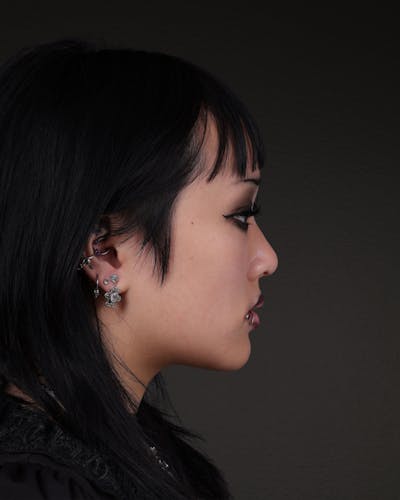 Rhinoplasty Before & After Gallery - Patient 113225 - Image 2
