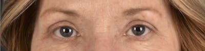 Blepharoplasty Before & After Gallery - Patient 943759 - Image 2