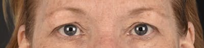 Blepharoplasty Before & After Gallery - Patient 943759 - Image 1