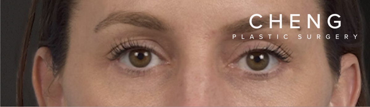 Blepharoplasty Before & After Gallery - Patient 117445 - Image 2