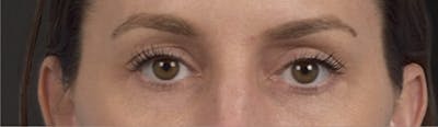 Blepharoplasty Before & After Gallery - Patient 117445 - Image 2