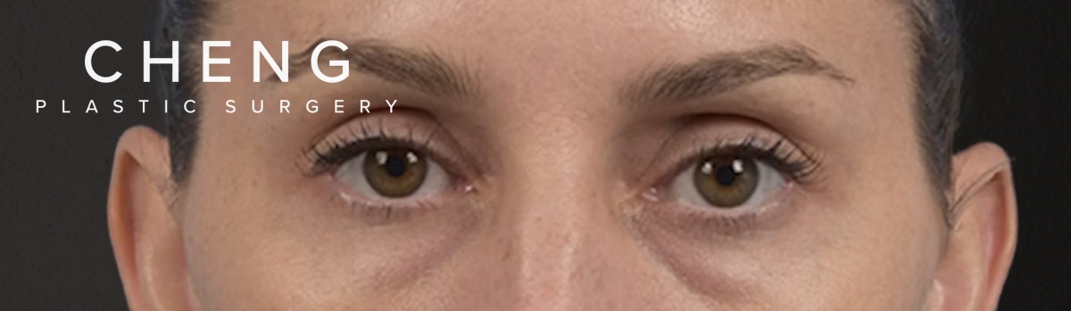 Blepharoplasty Before & After Gallery - Patient 117445 - Image 1