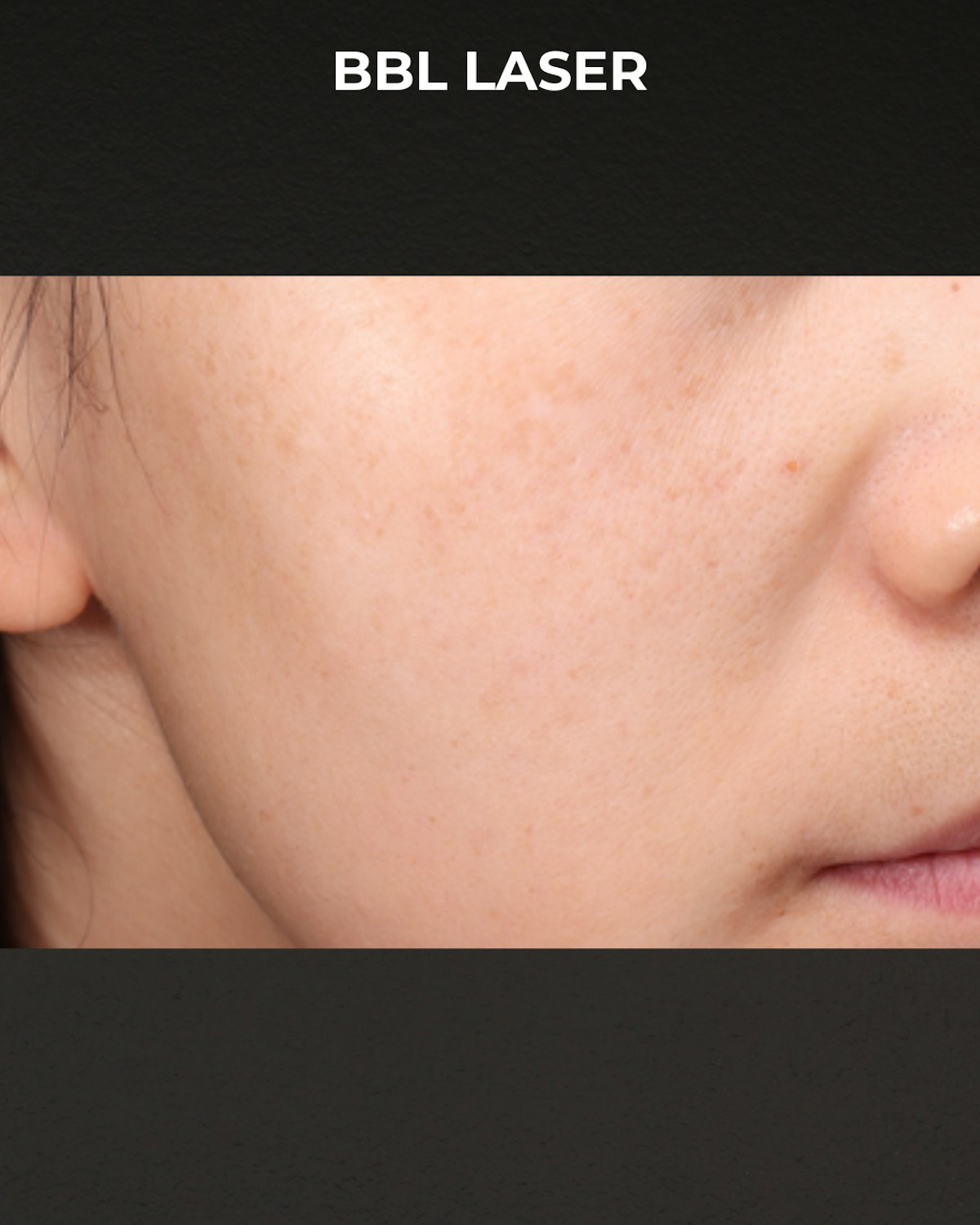Pigment Laser Before & After Gallery - Patient 260727 - Image 1