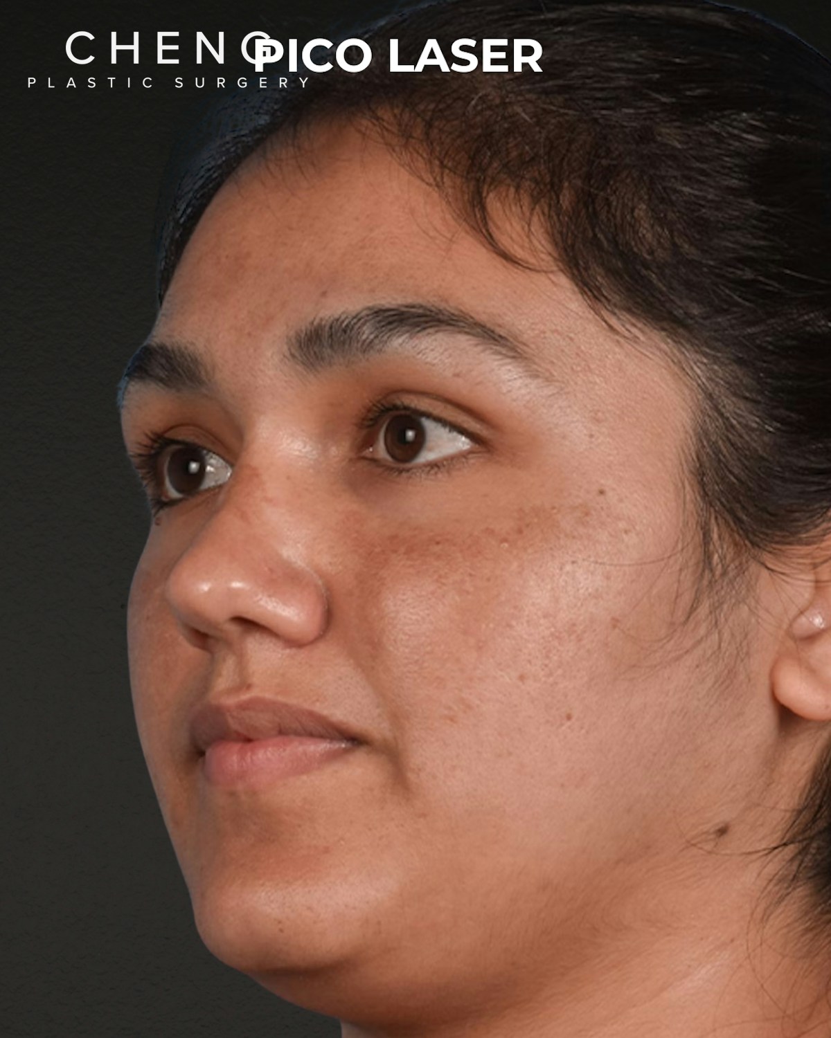 Pigment Laser Before & After Gallery - Patient 304638 - Image 3